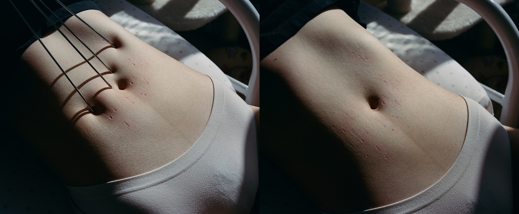 A diptych of an abdomen: metal rods press into the skin on the left, with an unobstructed view on the right.